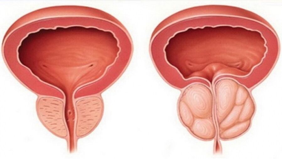 простатитпен сау және қабынған простата